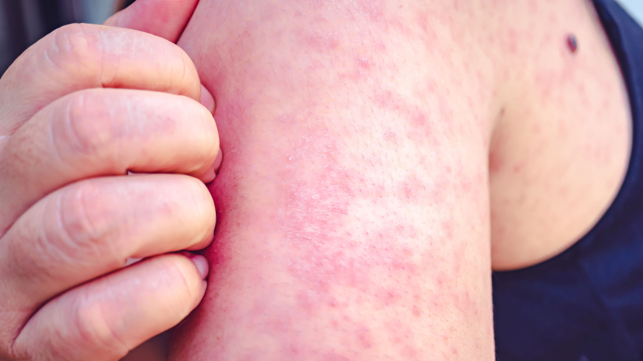 Sharp Rise In Ontario Measles: 223 Infections